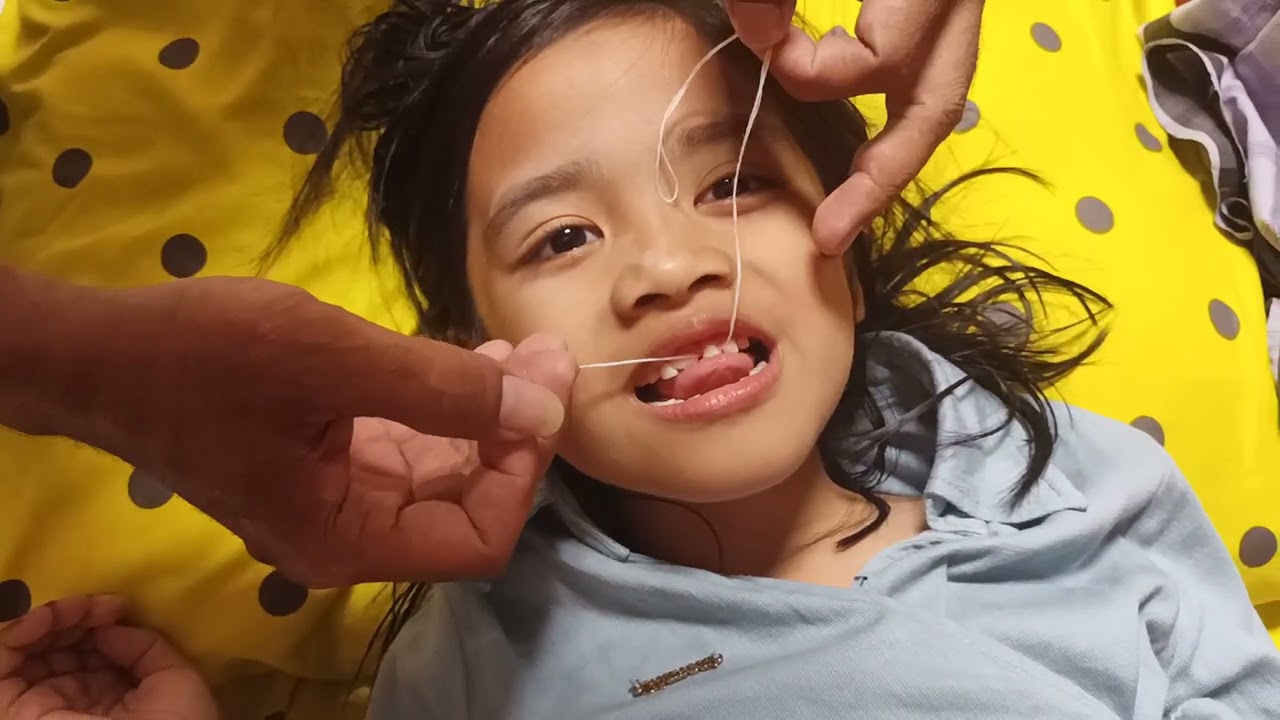Cara Cabut Gigi anak  secara mandiri yang sudah longgar, dengan Aman