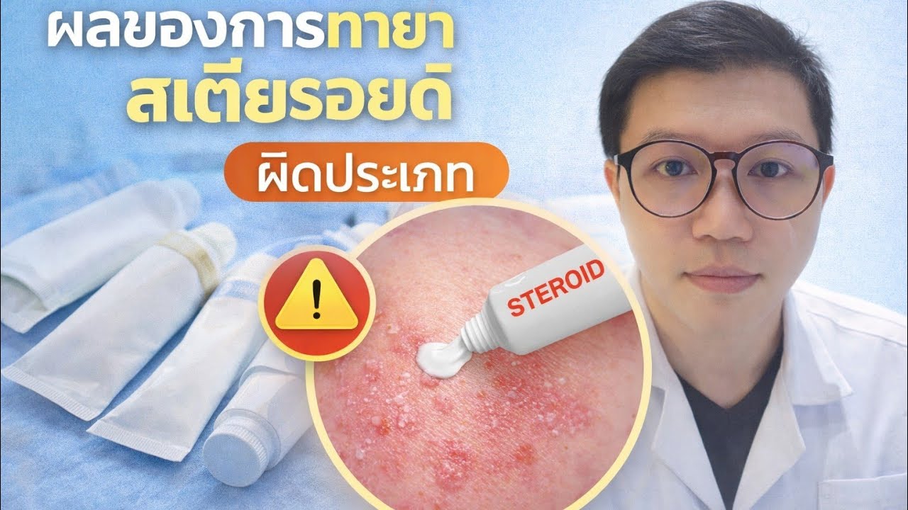 ผลของการทา ยาสเตียรอยด์ ผิดประเภท