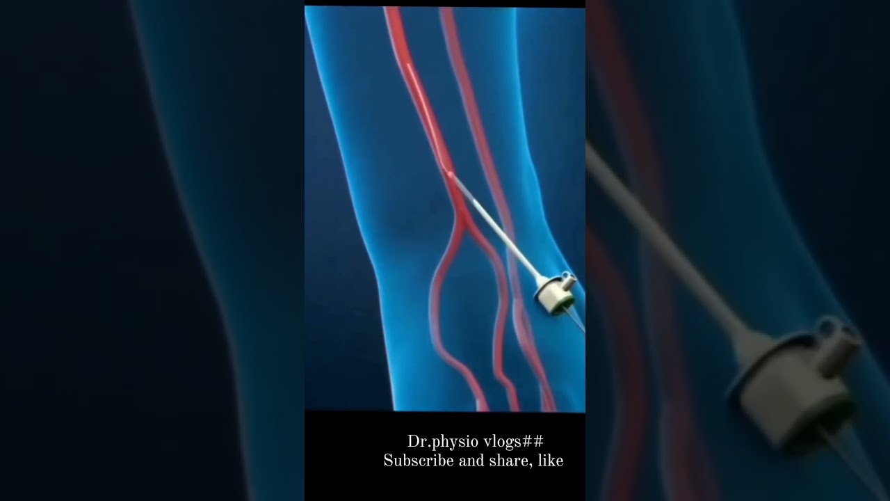 #Heart blockage treatment.....