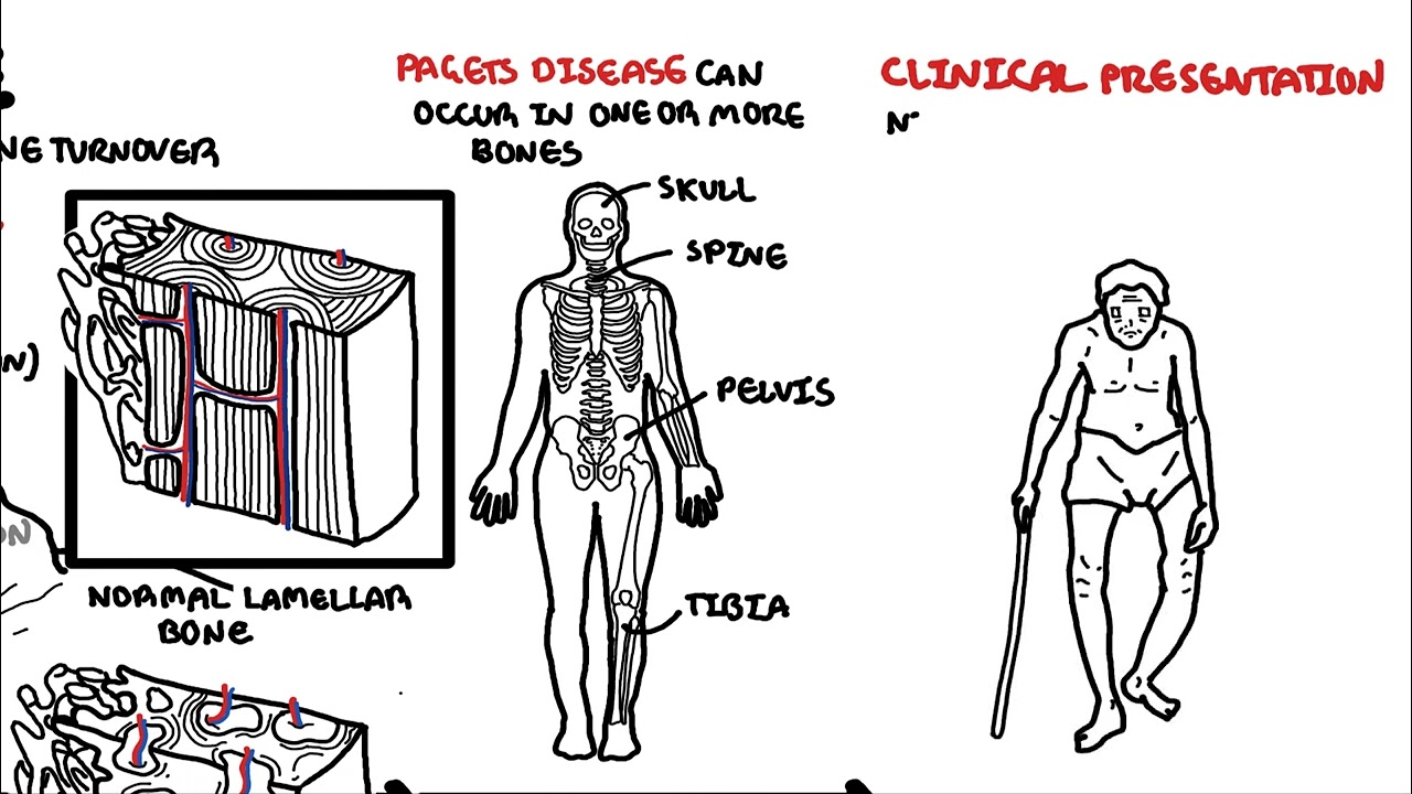 Paget's Disease of the bone