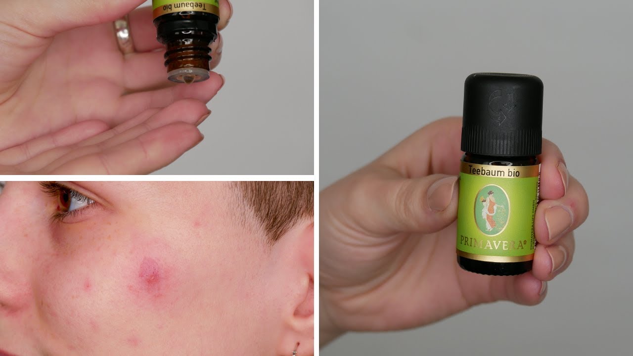 Can you apply Tea Tree Oil directly to Acne (Pimple) - Here is what happened to me