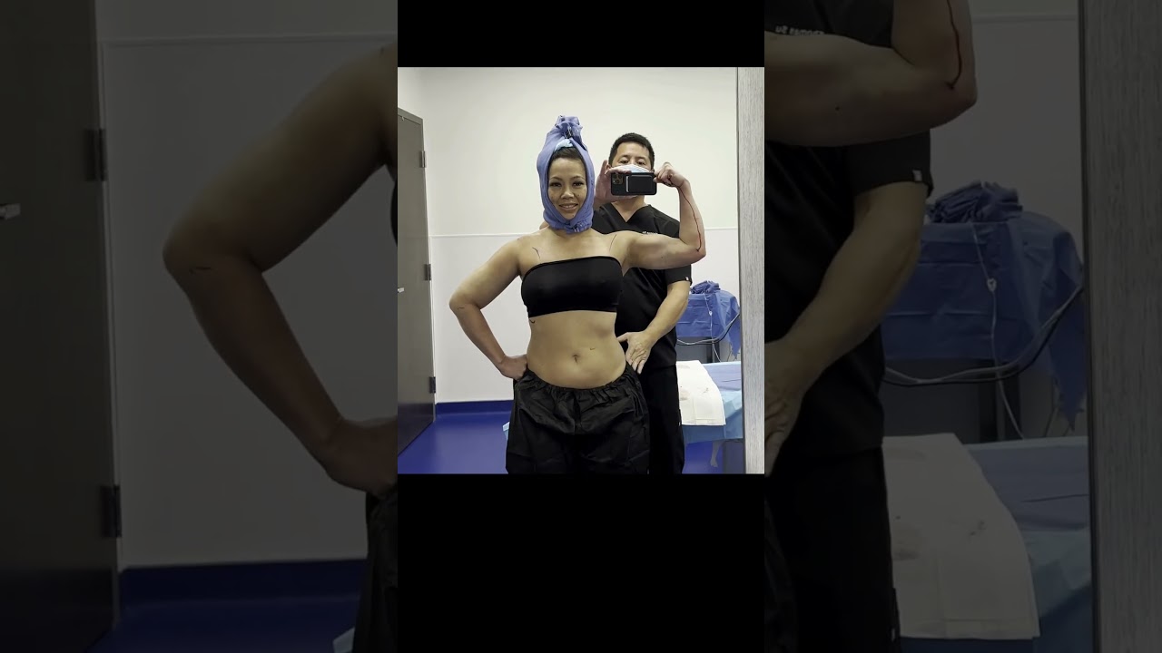 Celebrity Arms&trade; | 360&deg; Arm Liposuction | Immediate Results | Expert Dr. Thomas Su | Artlipo