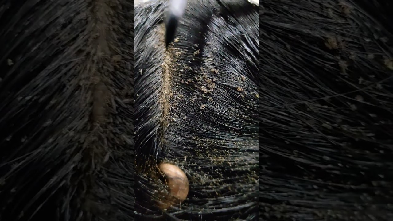 Nits lice treatment 100% result within 2 hrs Chennai #headliceremoval#liceremoval#nits#lice#headlice