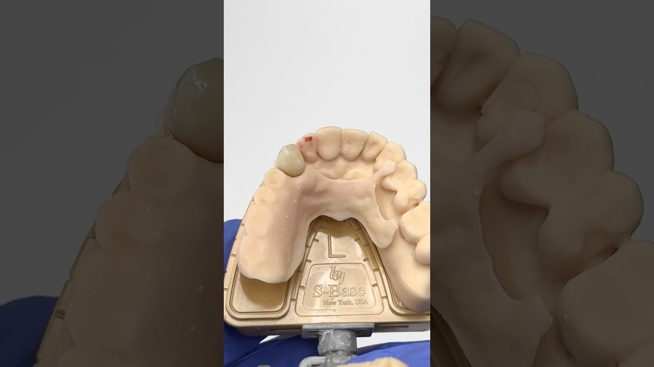 Single Crown with a Printed Partial Prototype @EnvisiontecMain #envisiontec #lsk121shorts #dental