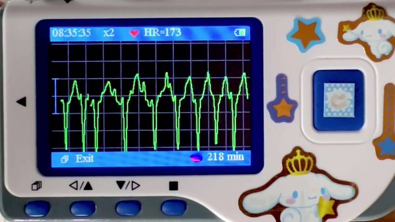 #111 圧迫中の心電図と不整脈な心音 Female Irregular Heartbeat ECG