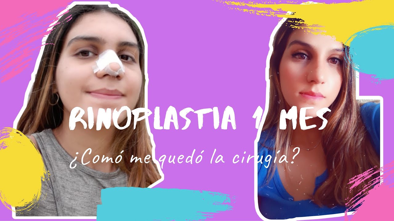 Rinoplastia mi experiencia y resultado 1 mes