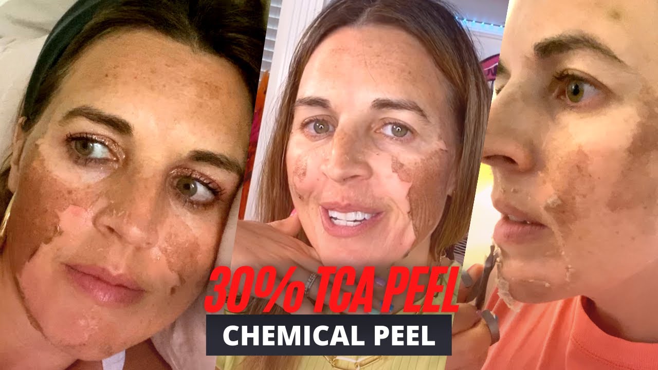 BEFORE AND AFTER 30% TCA Chemical Peel: Procedure, Peeling, Herpes