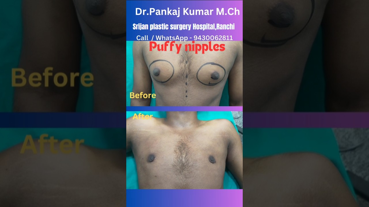 Puffy nipples treatment| Gynecomastia treatment in Ranchi 