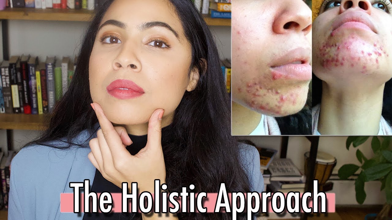 WHAT YOUR CHIN ACNE IS TRYING TO TELL YOU