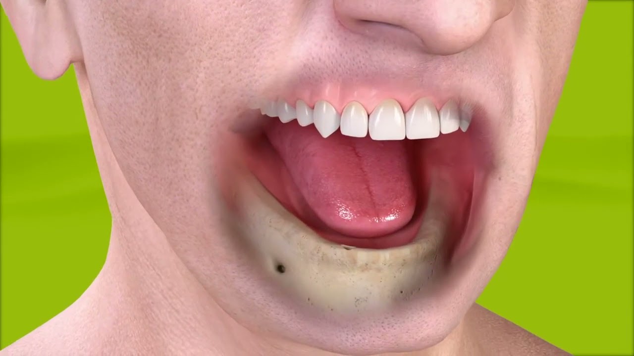 Removable denture with bar