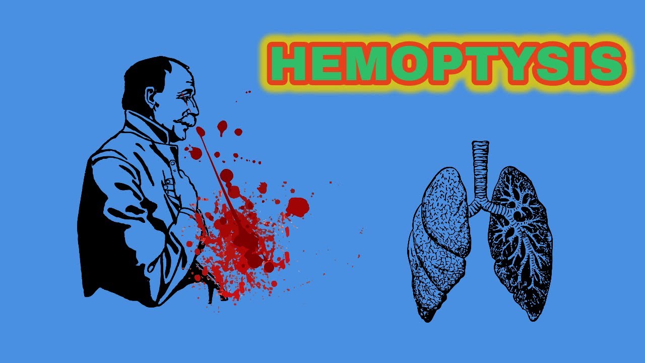 HEMOPTYSIS an analysis of blood in sputum