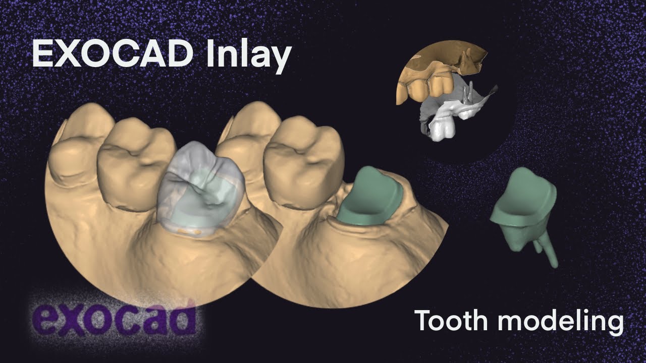 Exocad Inlay I Tooth modeling 10