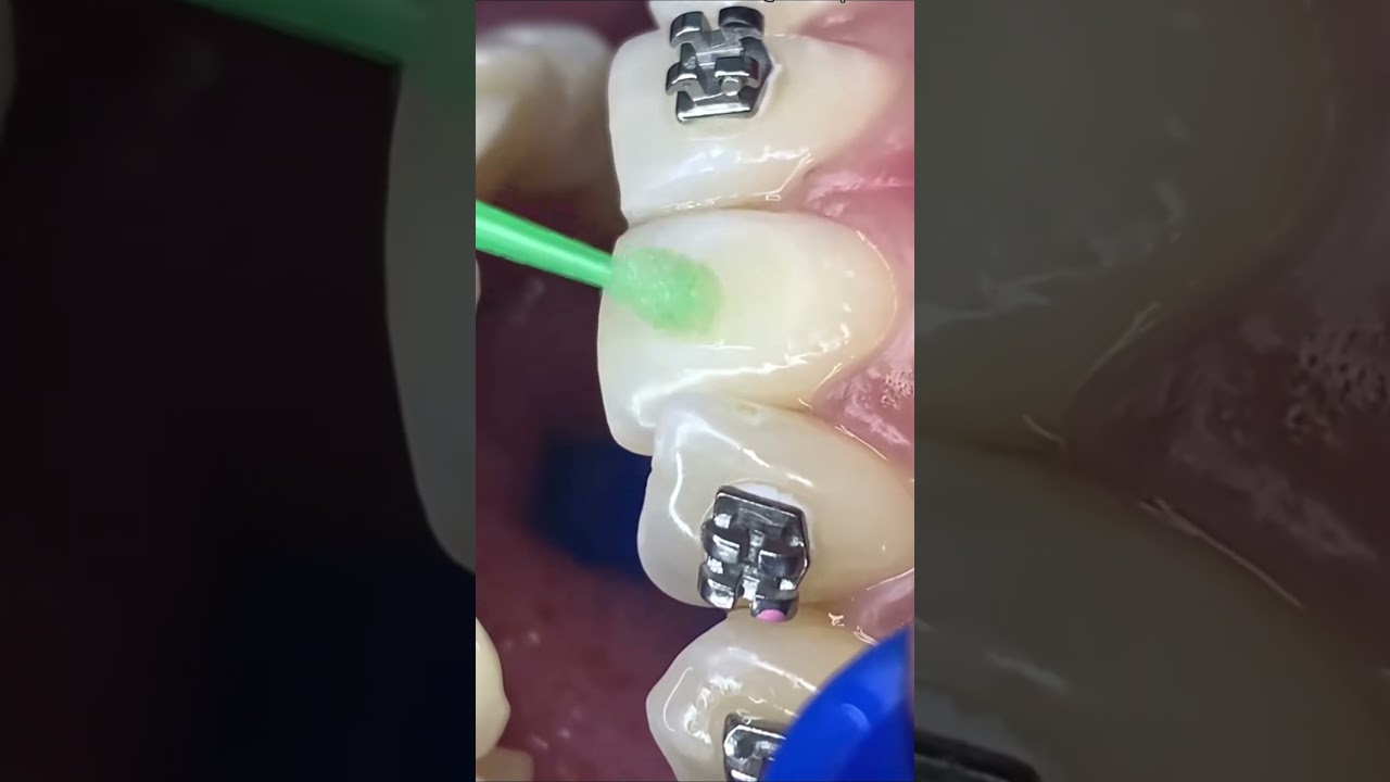 wow amazing #teeth #braces