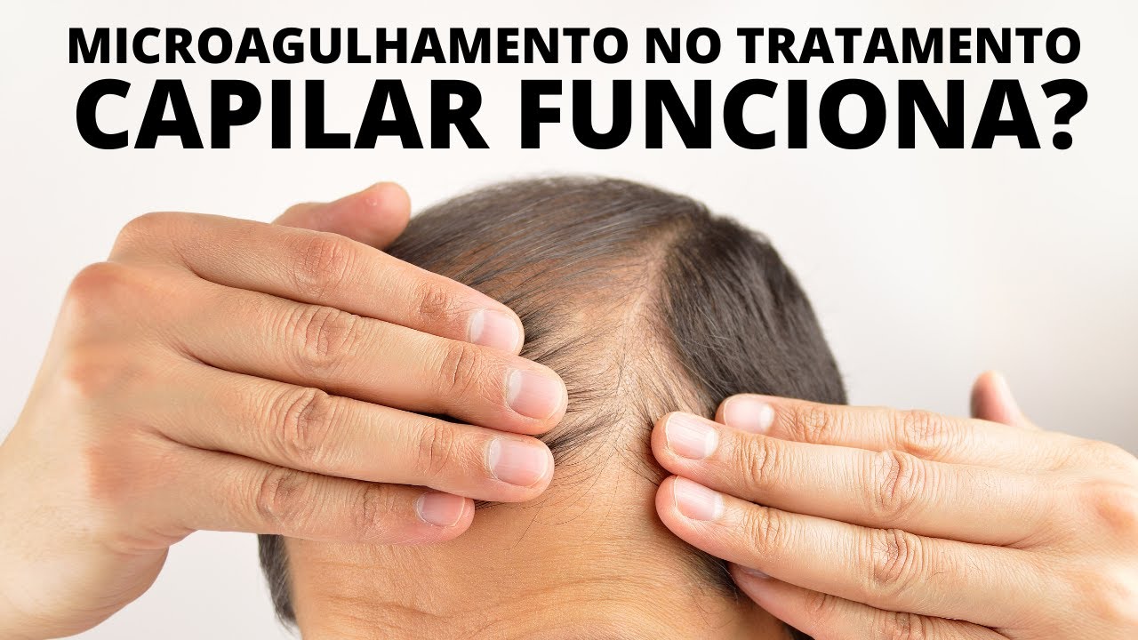 MICROAGULHAMENTO NO TRATAMENTO CAPILAR