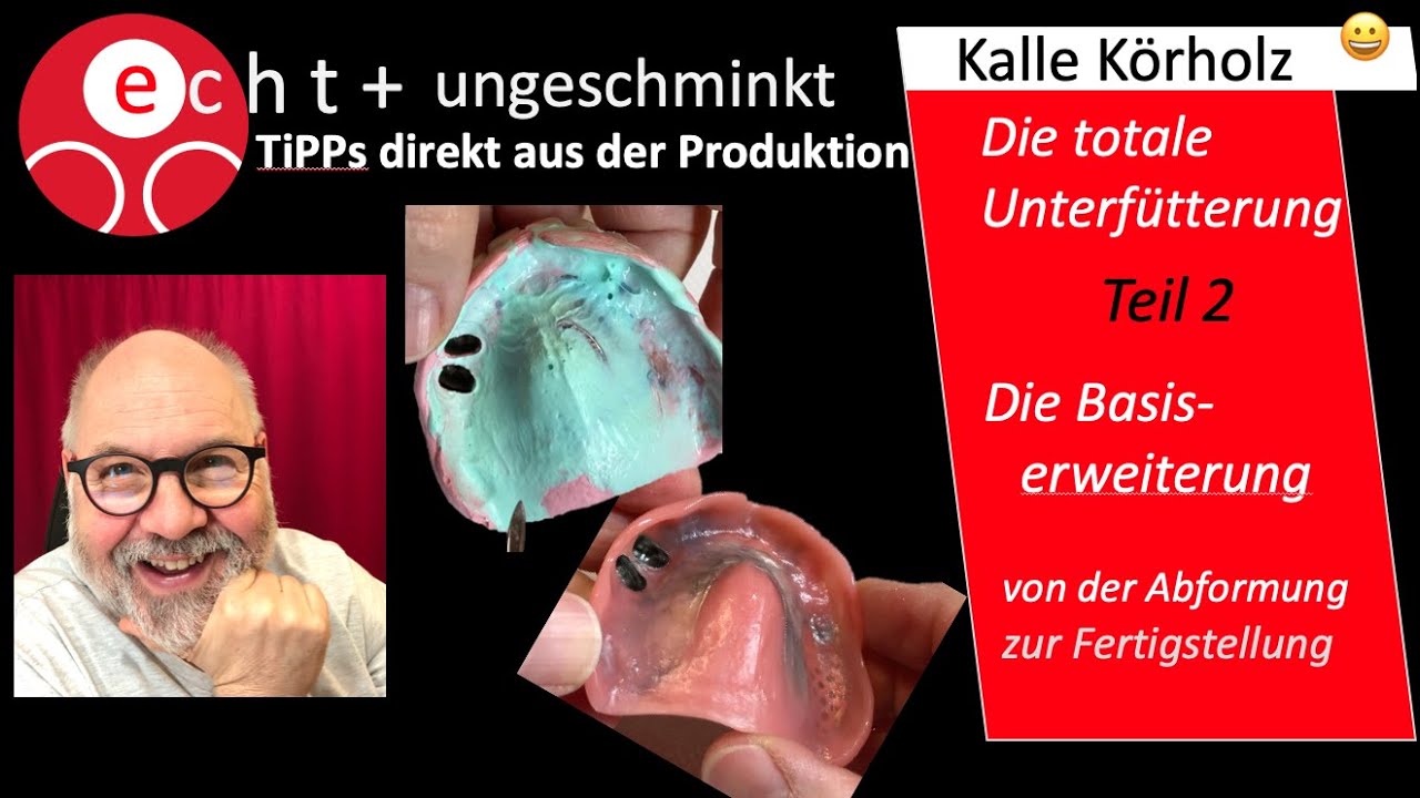 Unterfütterung/Basiserweiterung  -  2. Teil mit einer Teleskop-Prothese
