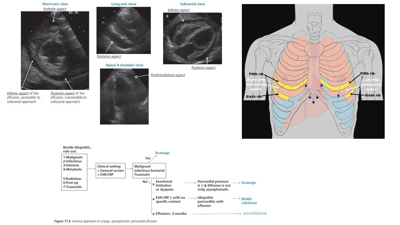 Tamponade, asymptomatic effusion, pericardiocentesis, constriction