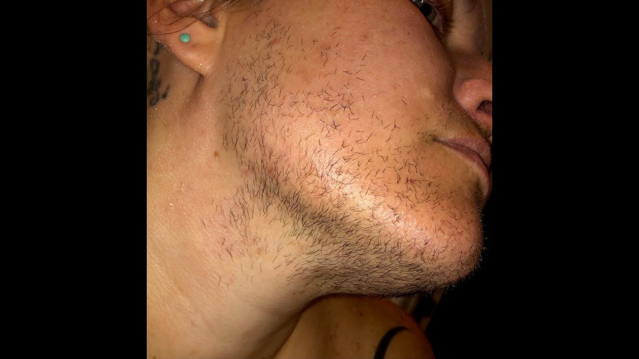 Laser made my facial hair worse (Paradoxical Hypertrichosis) vs. Electrolysis hair removal | PCOS