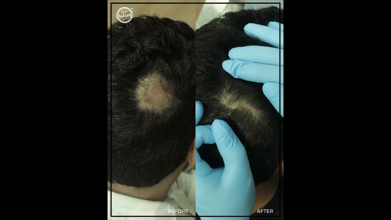 Alopecia Areata Recovery: Real Regrowth is Possible with Expert Care ✨
