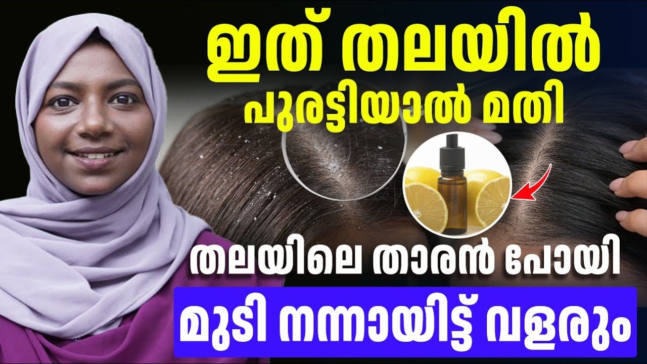 ഇതു തലയിൽ പുരട്ടിയാൽ നിങ്ങളുടെ താരൻ പൂർണമായി മാറ്റിയെടുക്കാം