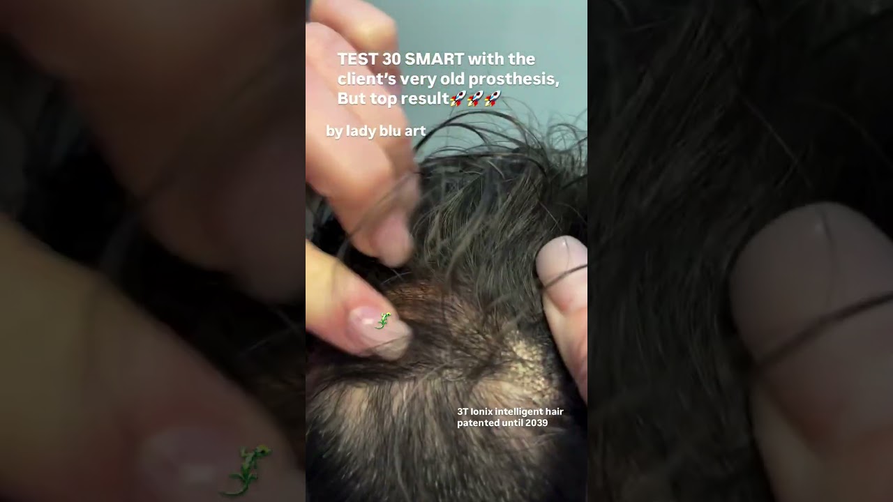 Alopecia areata: Trasformazione Incredibile con Tecnologia 3T Ionix