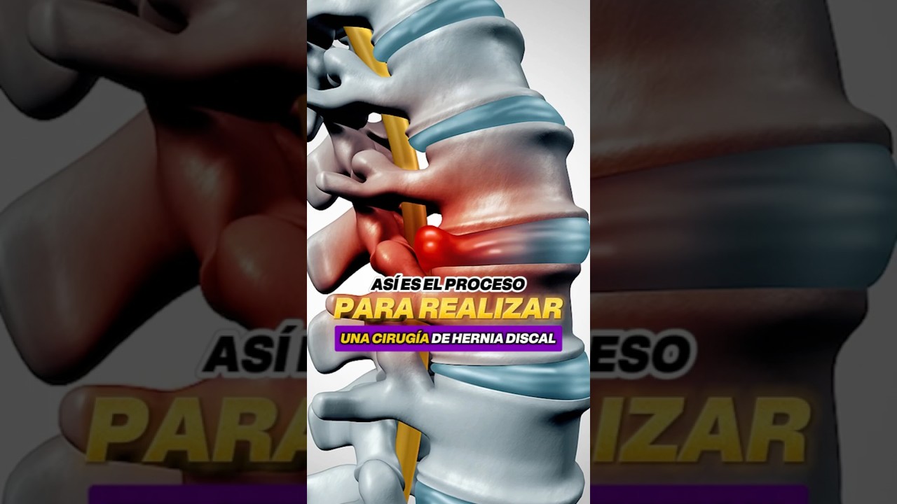 🩺💊 AS&Iacute; es el PROCESO ☝️ para REALIZAR una CIRUG&Iacute;A de HERNIA DISCAL ⚕️😯 @DrVic
