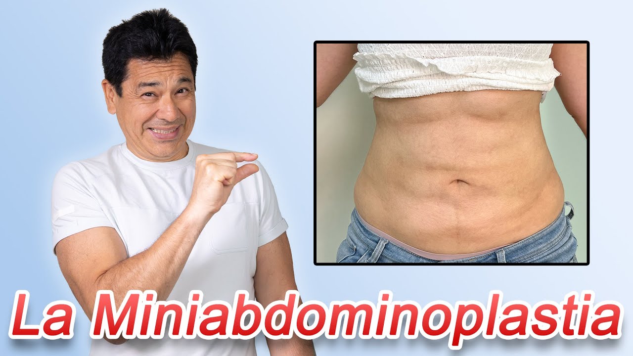 ¿Qué es la MINI Abdominoplastia?