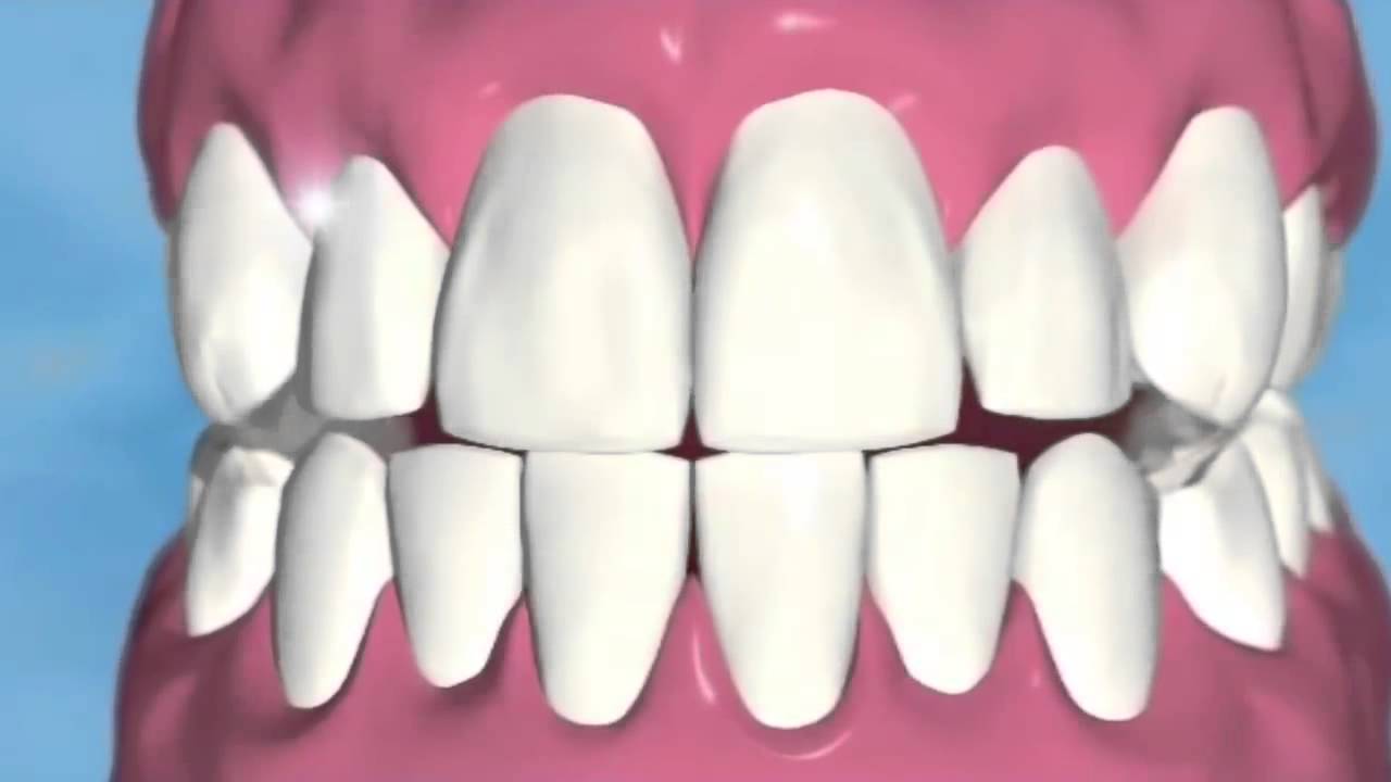 Power Swabs Teeth Whitening System - Seen on TV