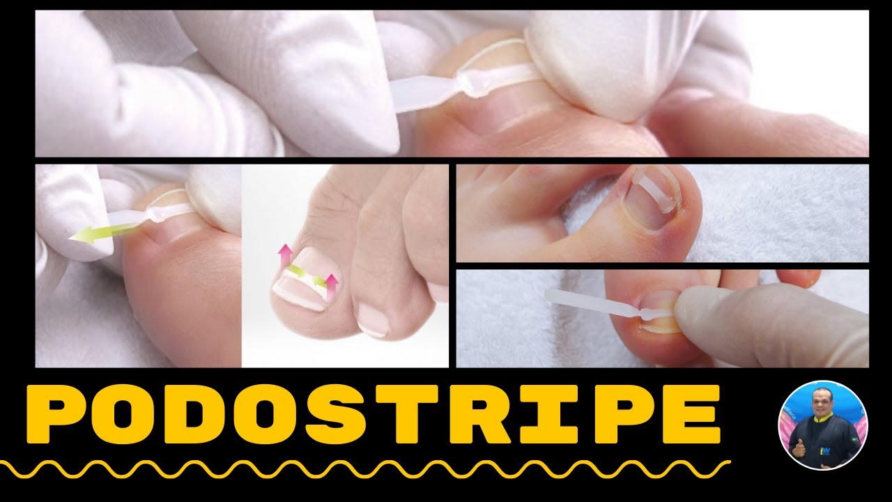 PODOSTRIPE - PARTE1