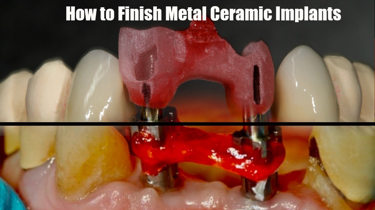 How to Finish Metal Ceramic Implants