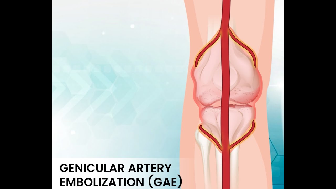Genicular Artery Embolization (GAE) | A minimally invasive solution for knee pain