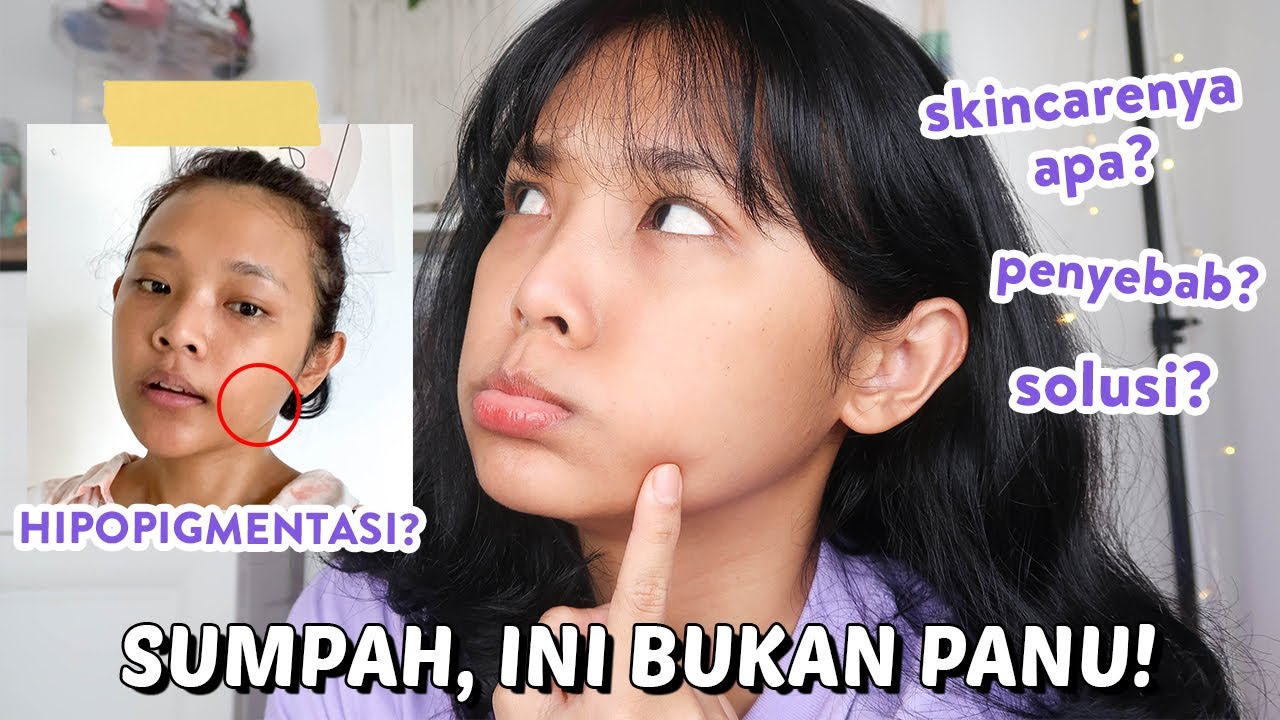 KULIT BELANG DISANGKA PANU l SKINCARE WARNA KULIT GAK RATA | RIRIEPRAMS