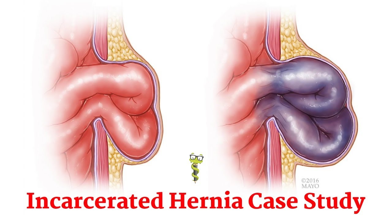 Incarcerated inguinal hernia
