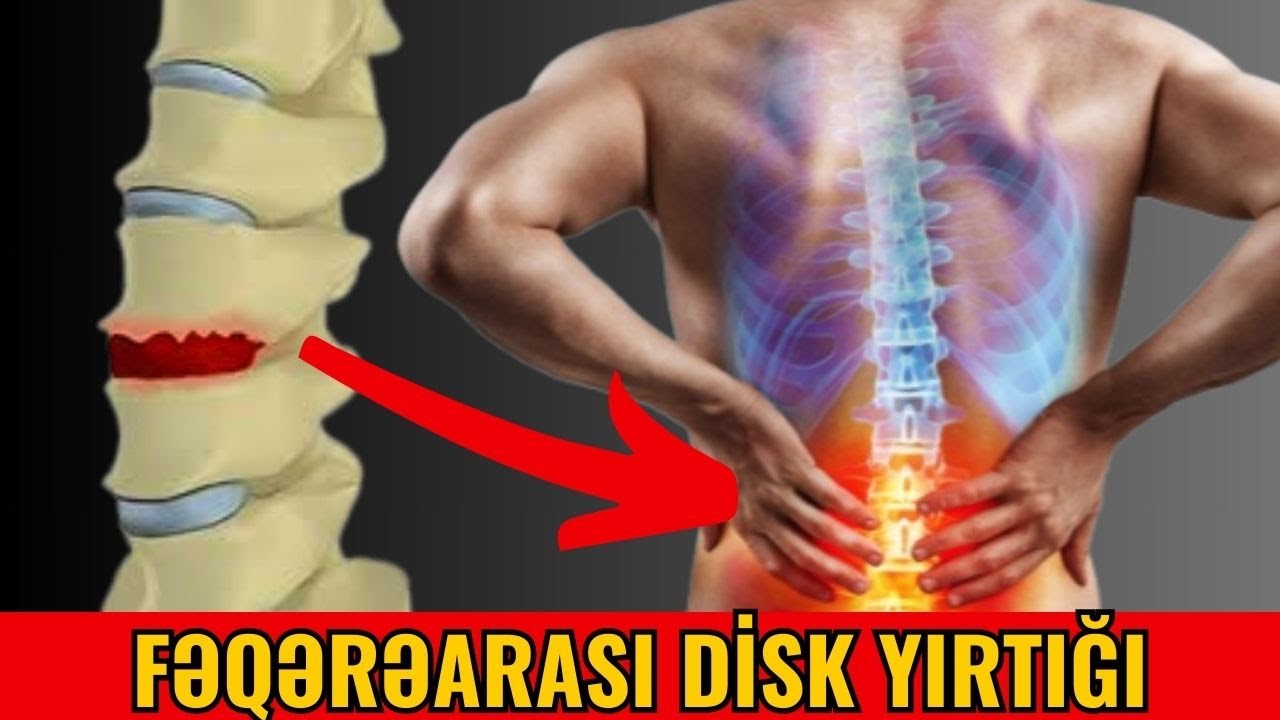 Disk Yırtığı əməliyyatından sonra necə həyat tərzi seçilməlidir #neyrocerrah #onurgacerrahı