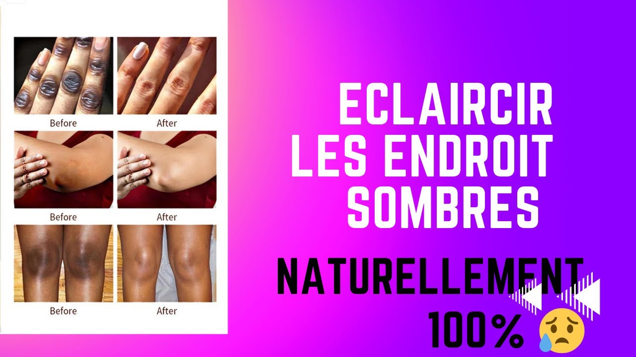 COMMENT SE DÉBARRASSER DES TACHES SOMBRES SUR LES GENOUX/COUDES/AISSELLES NATURELLEMENT 🤫🤫