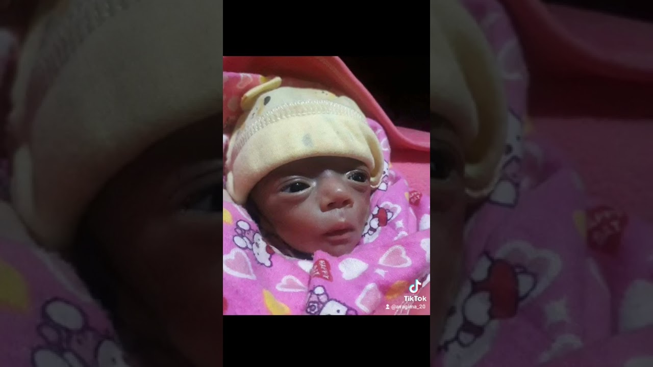 she is a patient of ROP stage 5 both eyes