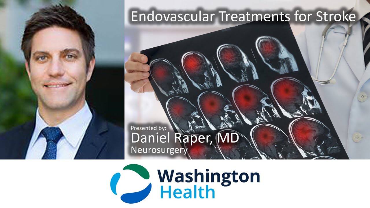 Endovascular Treatments for Stroke