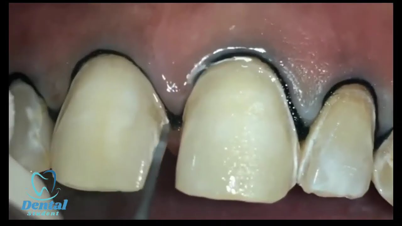 Indirect Veneer Preparation || Clinical case || Dr Eslam Zakzouk