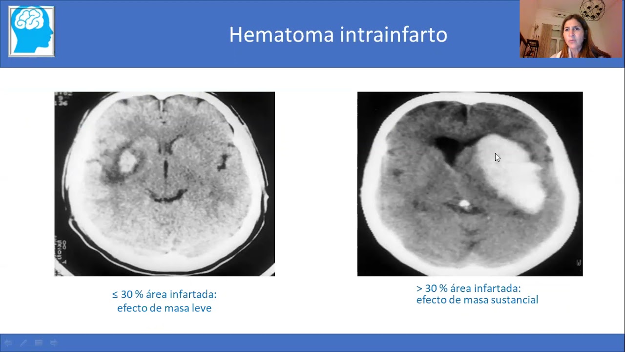 2  Anticoagulación en el paciente mayor  Situaciones complejas