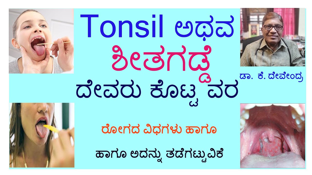 TONSILS  ಅಥವಾ ಶೀತಗಡ್ಡೆ ಎಂದರೇನು...    ವಿವರವಾಗಿ ತಿಳಿಸಿದ್ದಾರೆ ಡಾ ಕೆ ದೇವೇಂದ್ರ