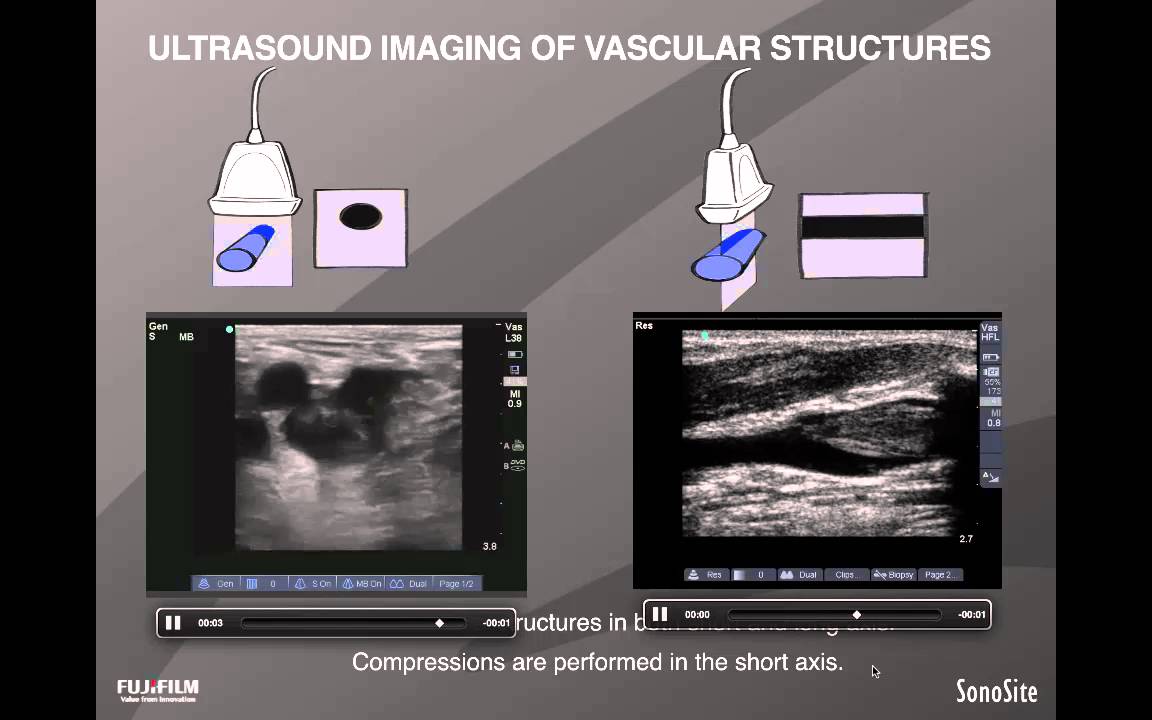 Webinar: Point-of-Care Ultrasound for the Detection of Lower Extremity DVT