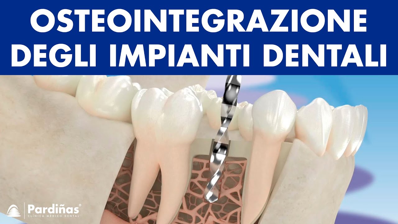 Le osteointegrazione degli impianti dentali ©