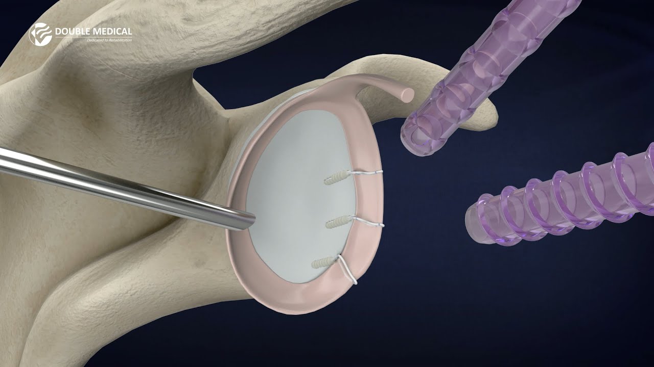 Double Medical 3.0 Knotless PEEK Suture Anchor - Revolutionizing Shoulder Instability Repair