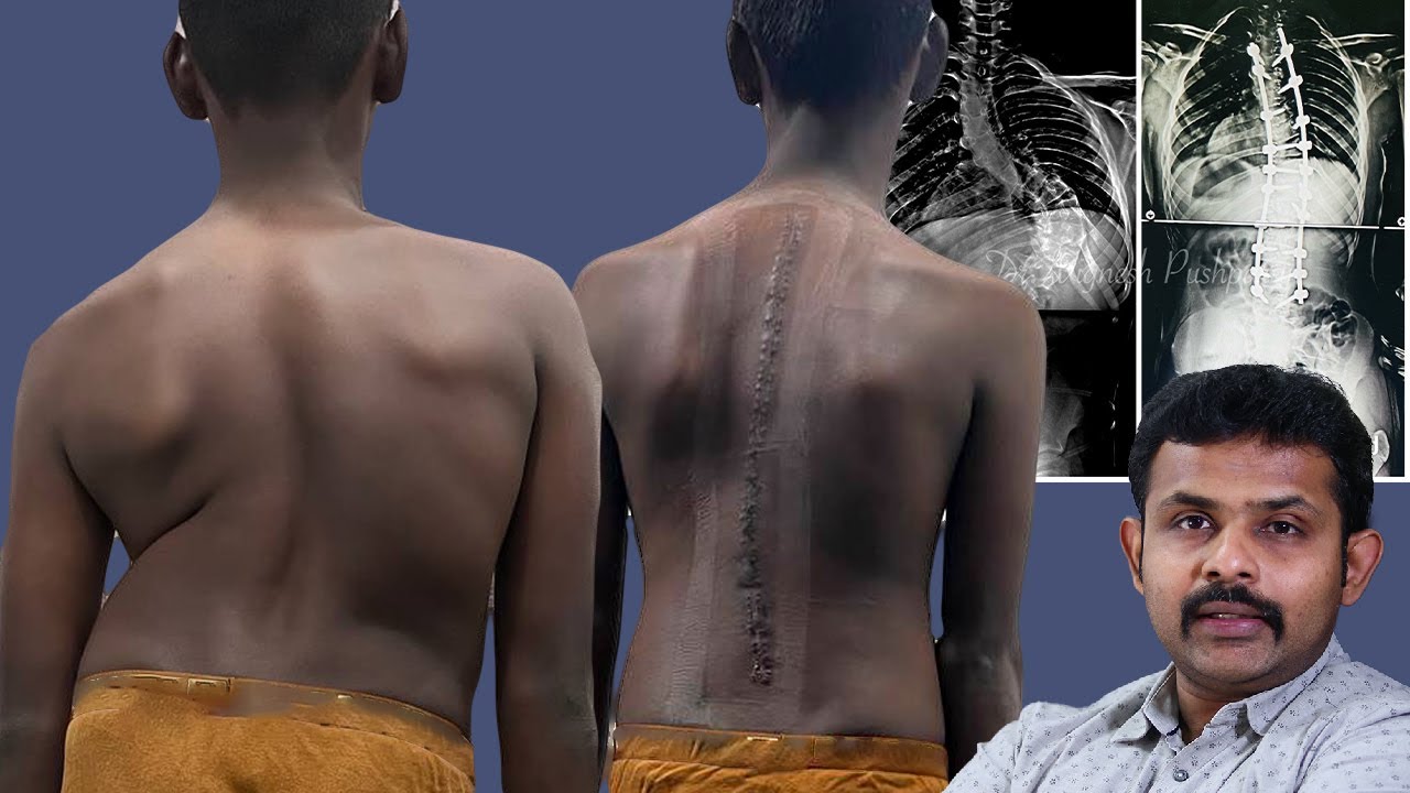 Life After Scoliosis- Scoliosis Surgery Success Story Part 2 Dr. Vignesh Pushparaj
