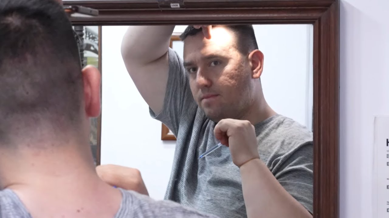 Getting Rid of Acne Scars on Face | Pre Surgery Consultation