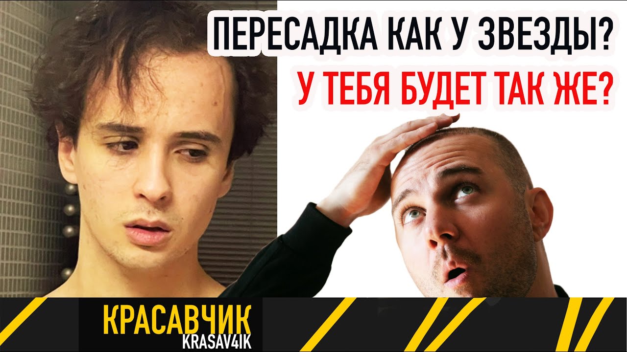 Пересадка как у звезды, Слава Марлоу сделал пересадку? \ Красавчик