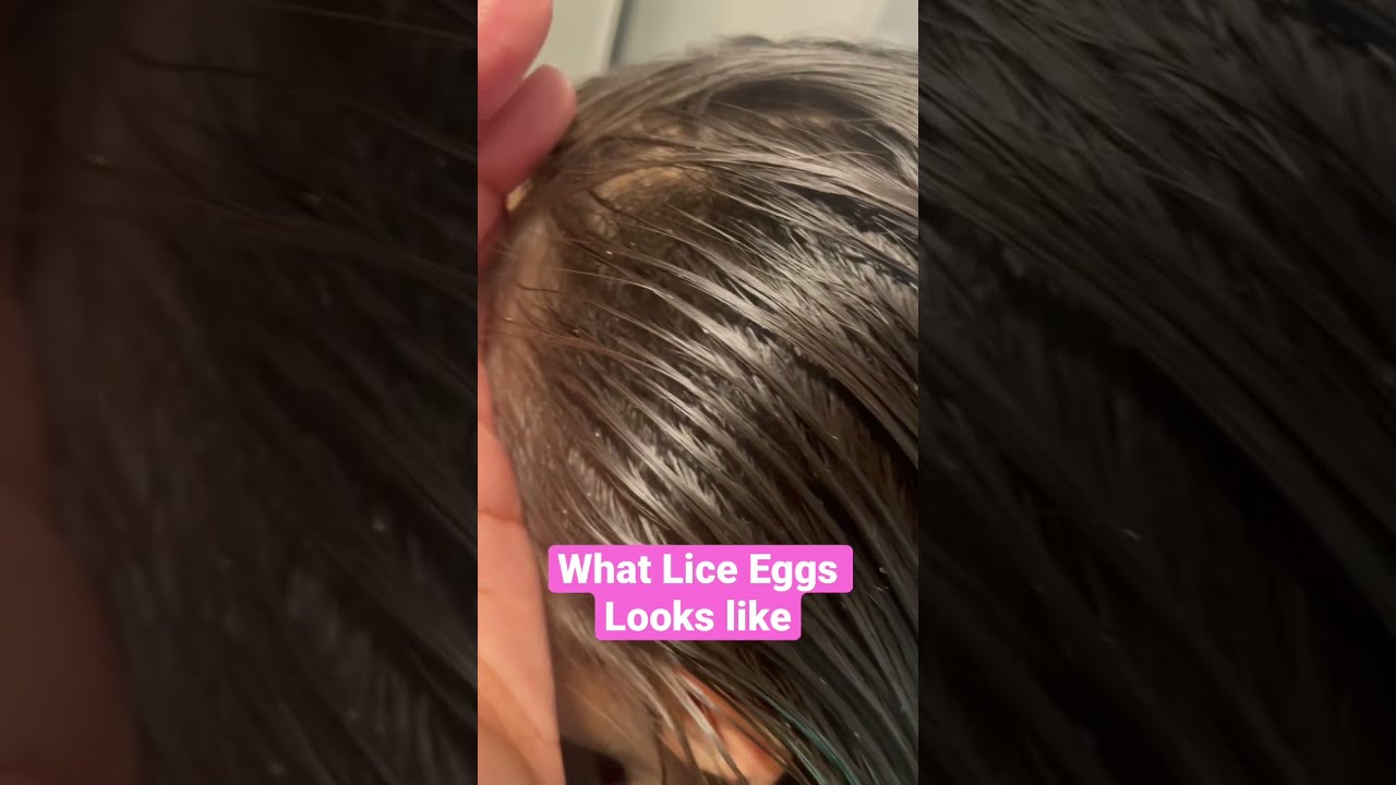 What Lice Eggs Looks Like l Lice Infestation @Thelousegirl