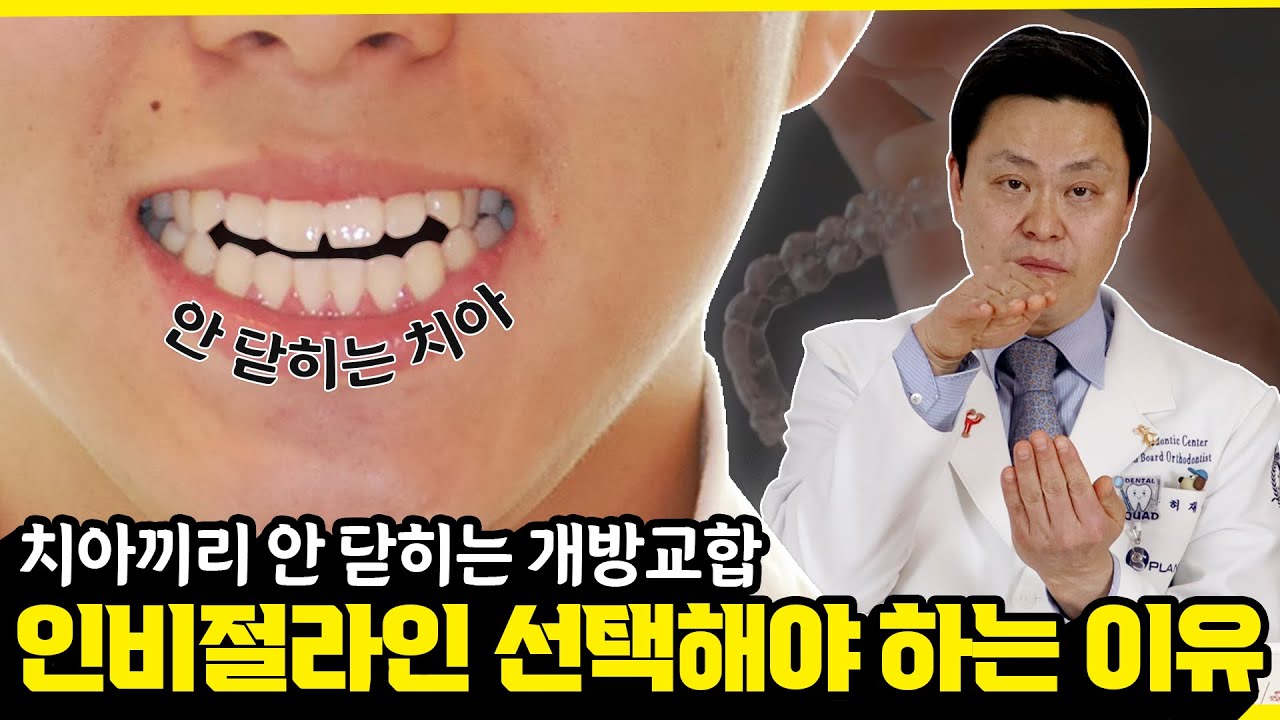 [교정일타 허원장] 입이 안 닫히는 개방교합 교정 전후 얼굴길이? 어떤 장치가 가장 좋나요?