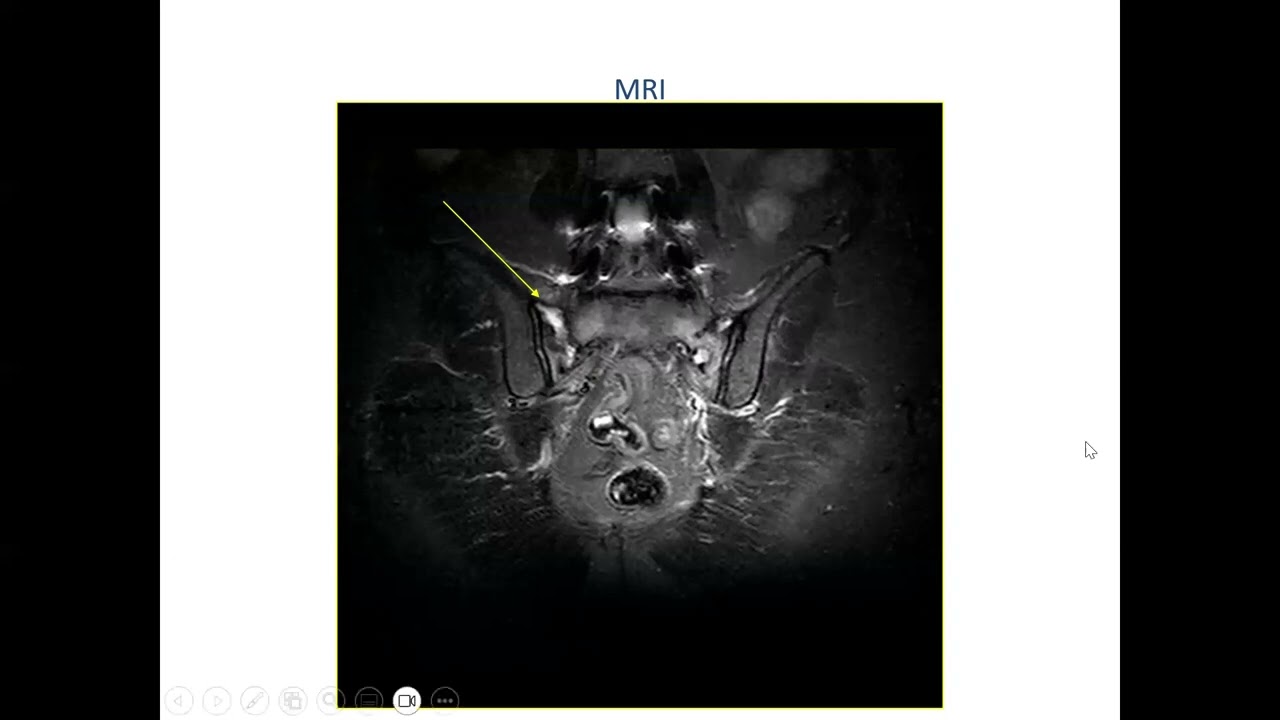 Prof Sithombo Maqungo- Pelvic fragility fractures 2024
