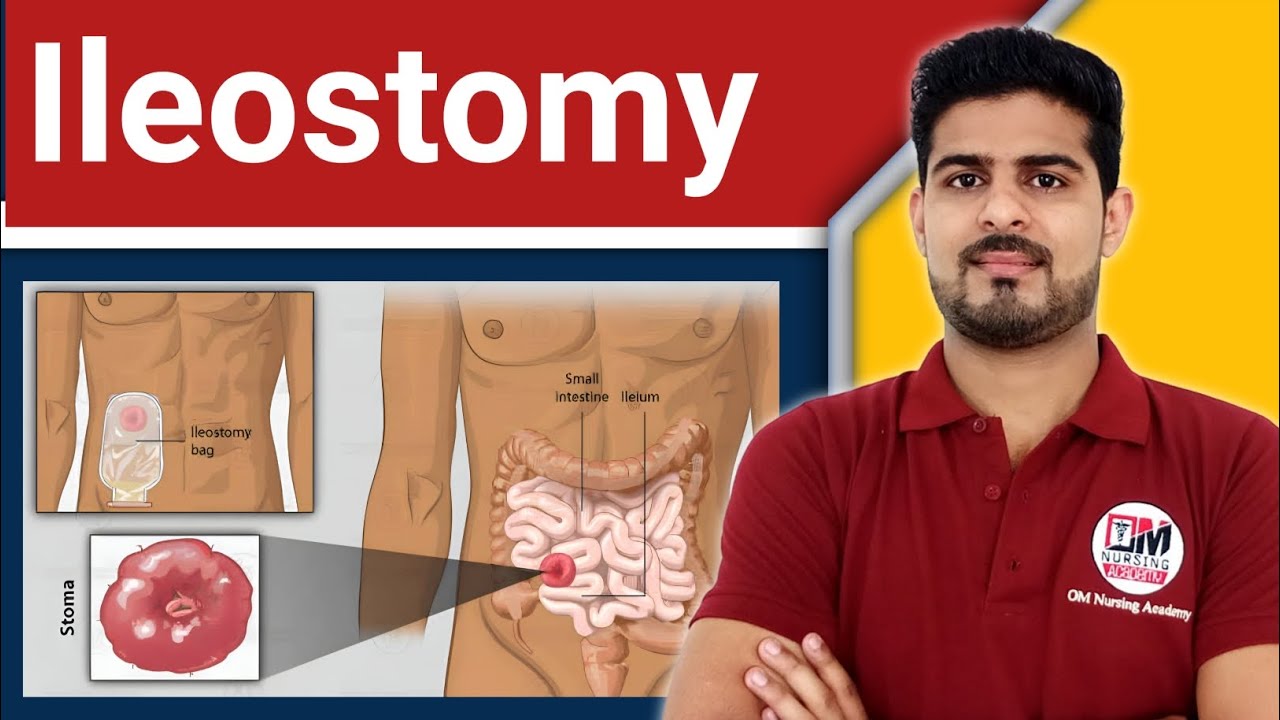 Ileostomy | Types | Procedure | Role of Nurse in Stomach Care
