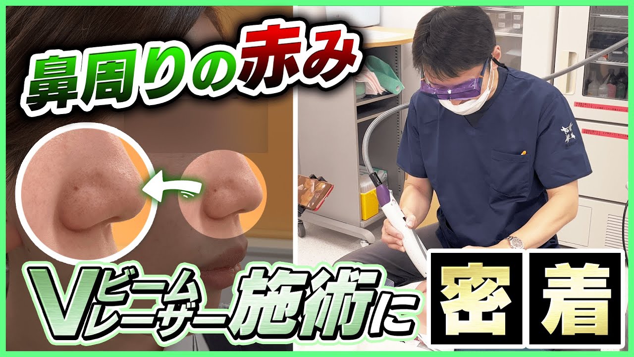 【肌治療】鼻周りの赤みをVビームプリマで治療！レーザー治療 完全密着！